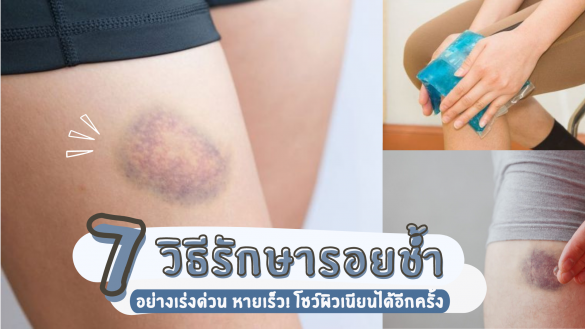 วิธีรักษารอยช้ำ